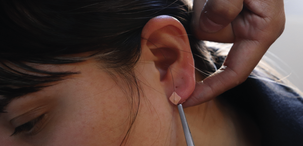 auriculoterapia